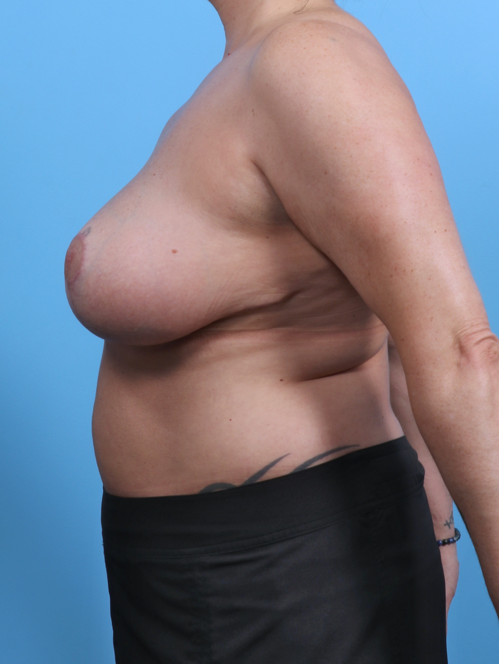 Breast Lift/Reduction Patient Photo - Case 3562 - after view-2