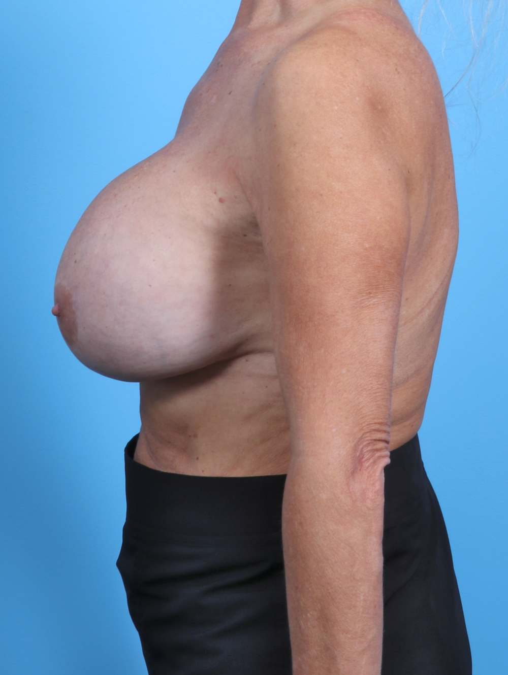 Breast Implant Revision Patient Photo - Case 3578 - before view-2
