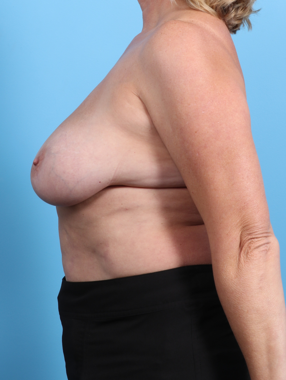 Breast Lift/Reduction Patient Photo - Case 3594 - before view-2