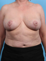 Breast Lift/Reduction - Case 3594 - After