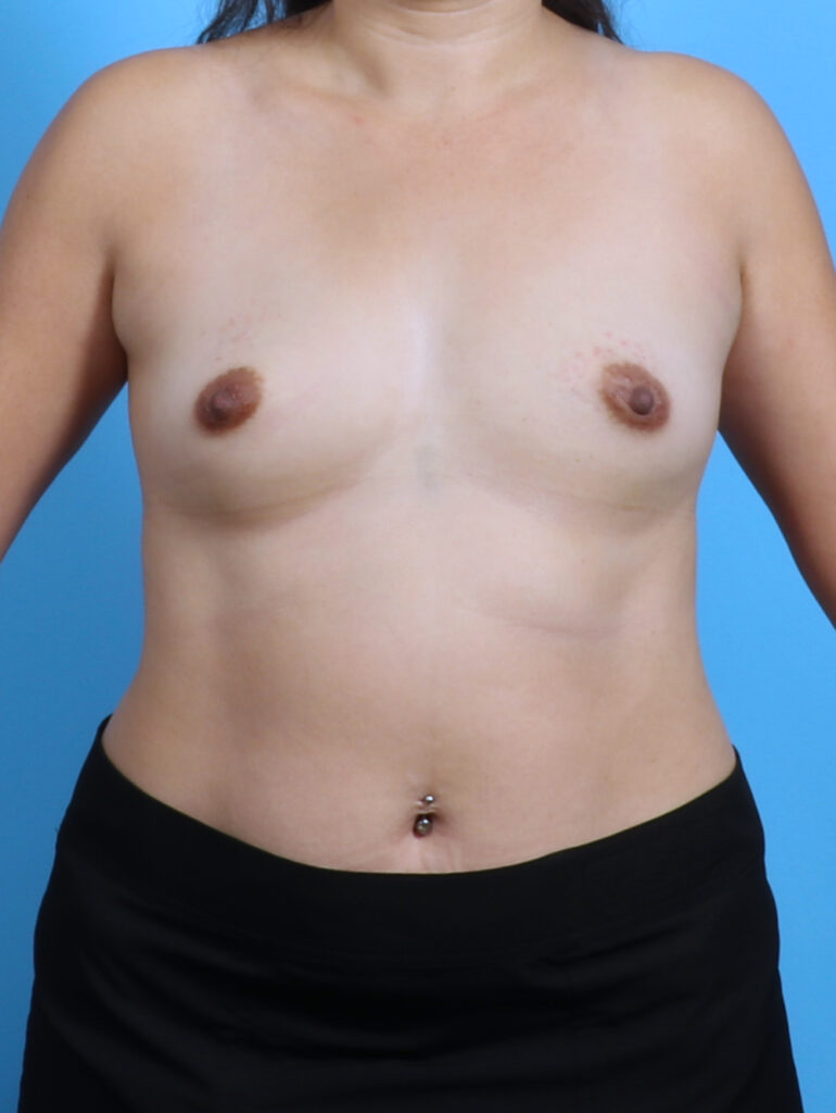 Breast Augmentation - Case 3649 - Before