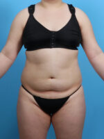 Liposuction - Case 3683 - Before