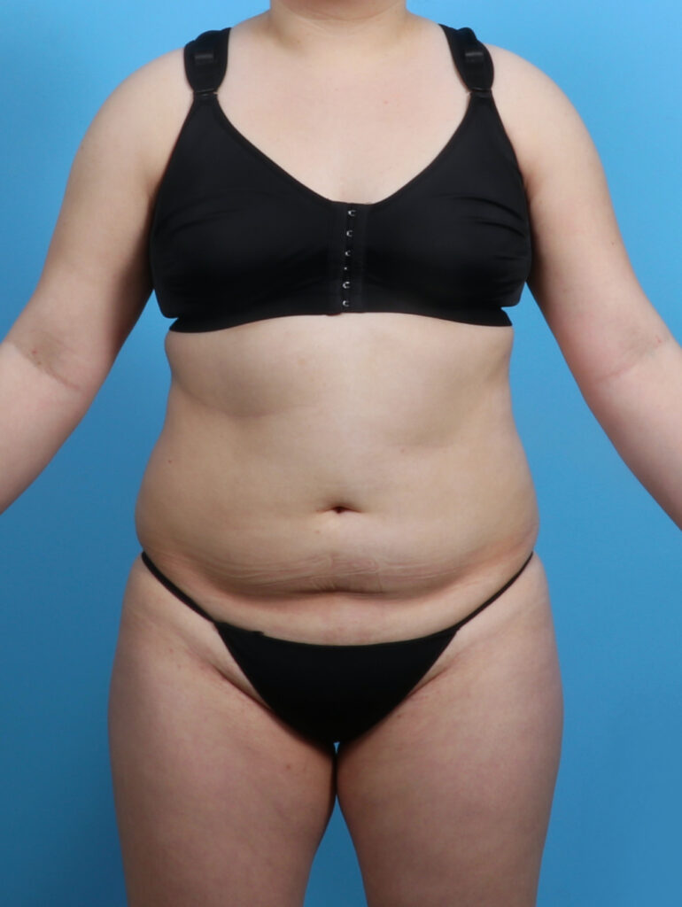 Liposuction - Case 3683 - Before