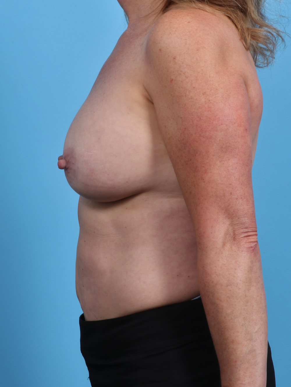 Breast Implant Revision Patient Photo - Case 3709 - before view-2