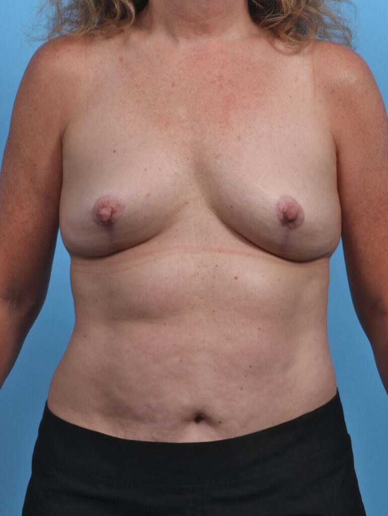 Breast Implant Revision - Case 3709 - After