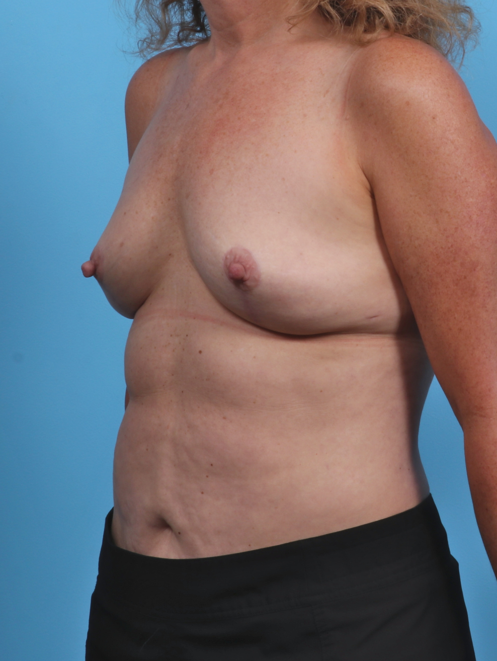 Breast Implant Revision Patient Photo - Case 3709 - after view-1