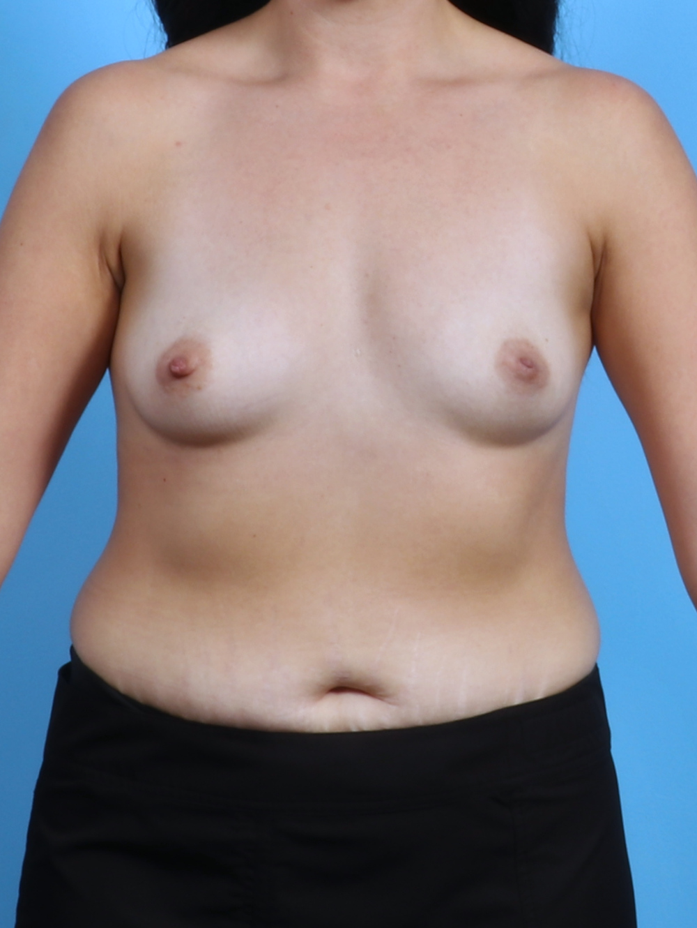 Breast Augmentation Patient Photo - Case 3739 - before view-