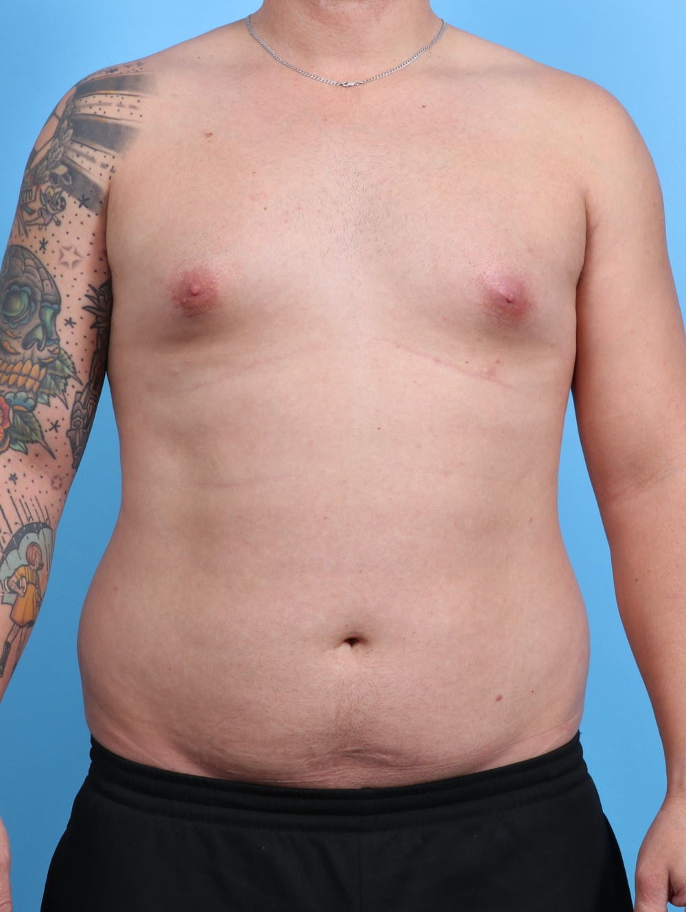 Male Breast Reduction Patient Photo - Case 3763 - before view-0