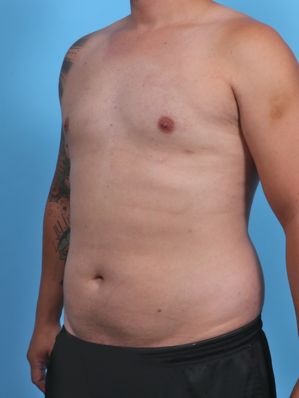 Male Breast Reduction Patient Photo - Case 3763 - after view-1