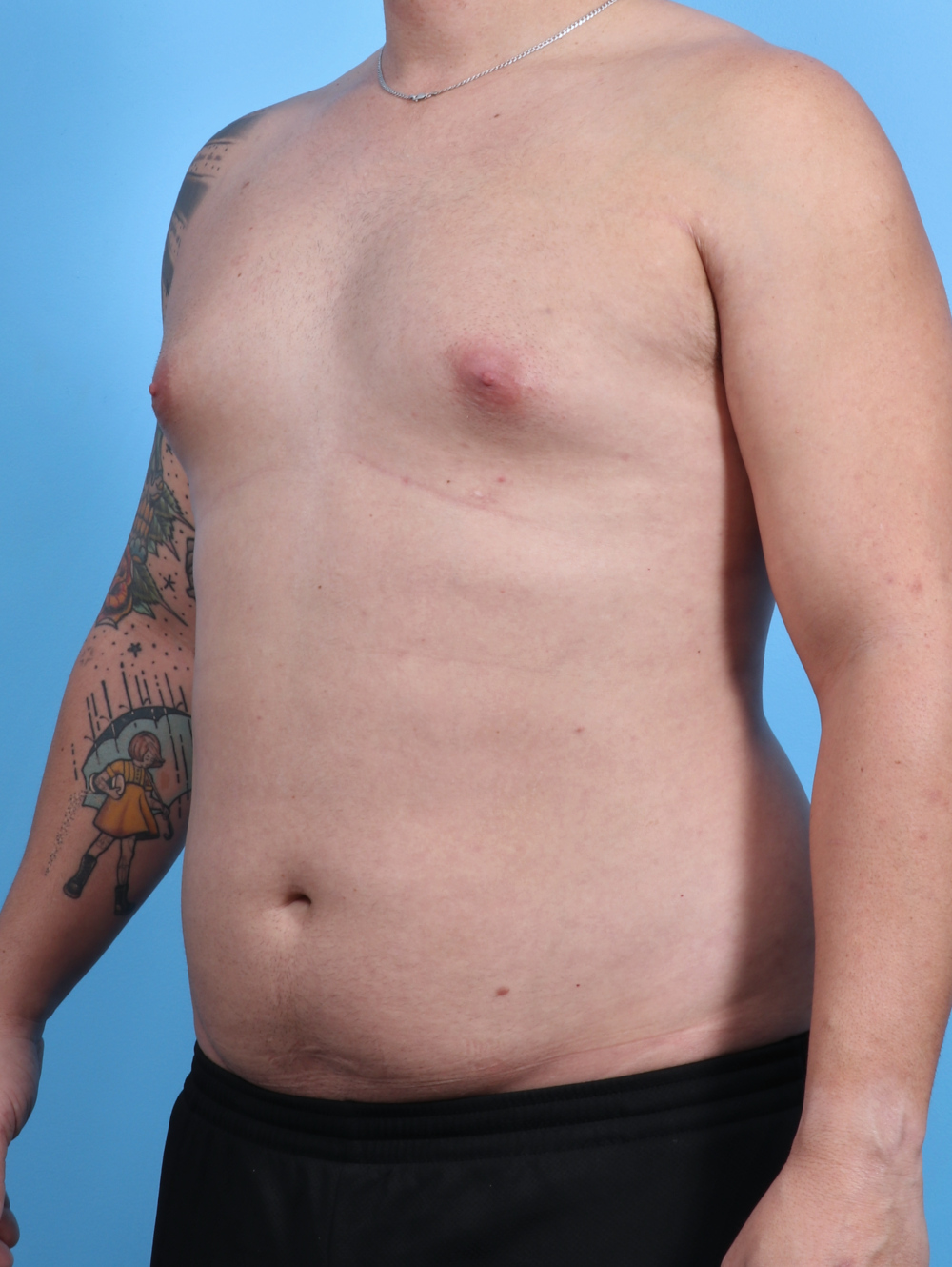 Male Breast Reduction Patient Photo - Case 3763 - before view-1