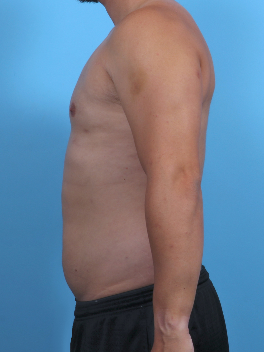 Male Breast Reduction Patient Photo - Case 3763 - after view-2