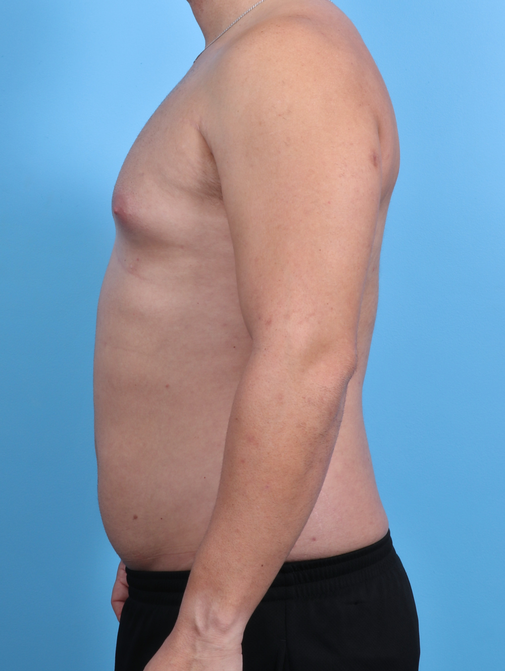 Male Breast Reduction Patient Photo - Case 3763 - before view-2