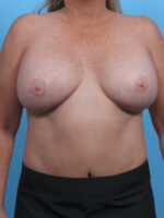 Breast Implant Revision - Case 3771 - After