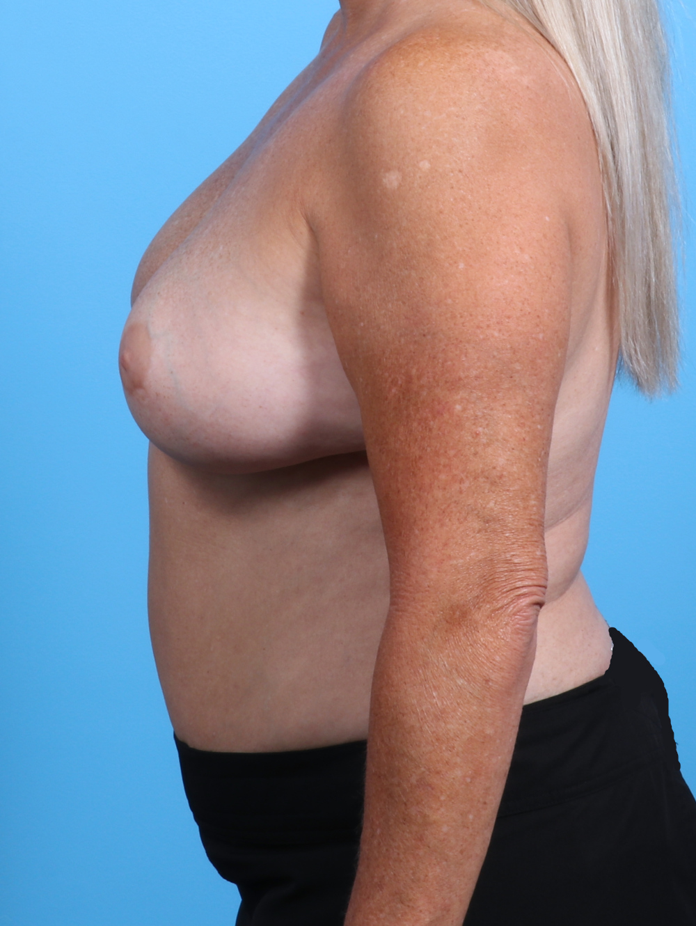 Breast Implant Revision Patient Photo - Case 3771 - before view-2
