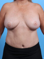 Breast Implant Revision - Case 3771 - Before