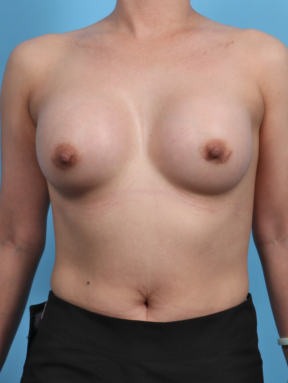 Breast Augmentation Patient Photo - Case 3779 - after view-0