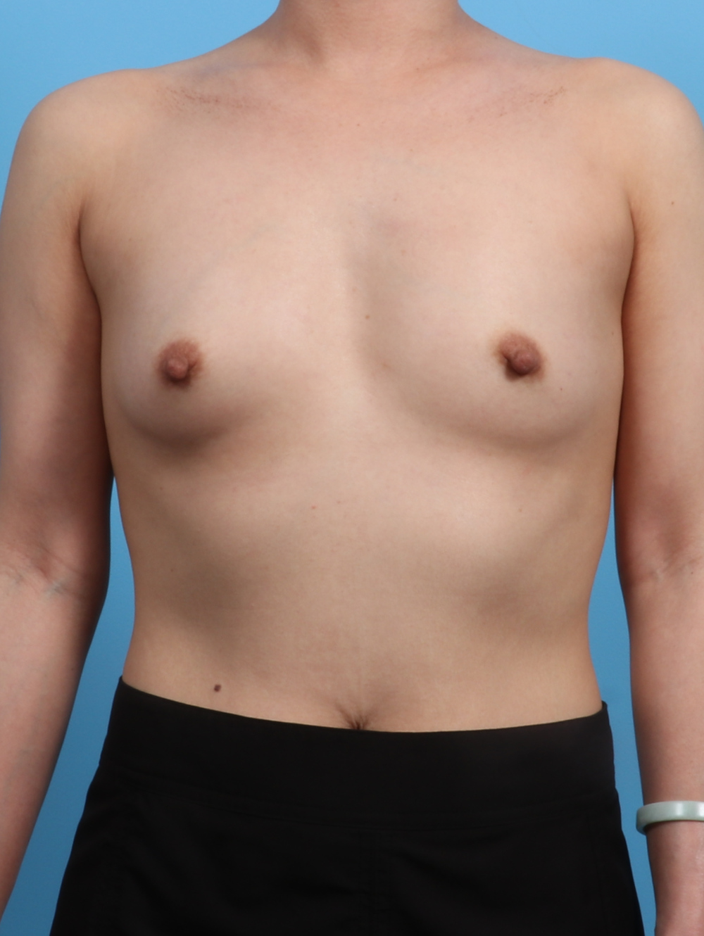 Breast Augmentation Patient Photo - Case 3779 - before view-