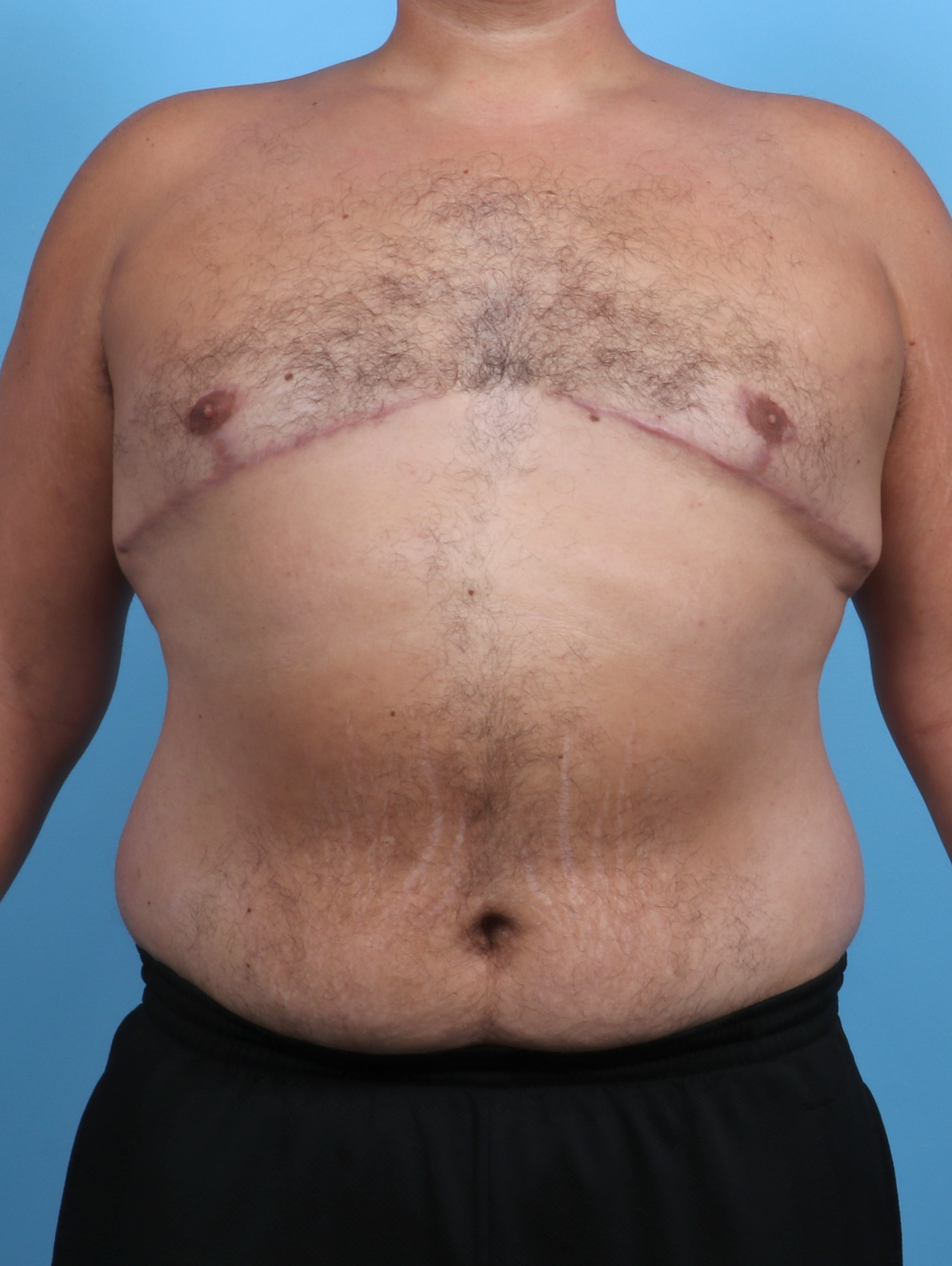 Male Breast Reduction Patient Photo - Case 3795 - after view