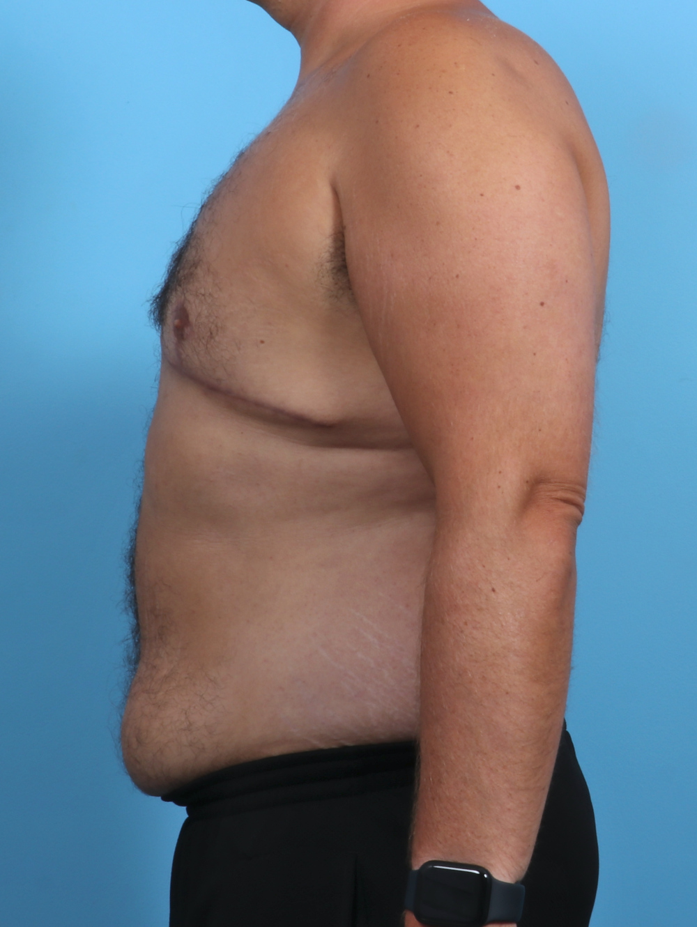 Male Breast Reduction Patient Photo - Case 3795 - after view-2