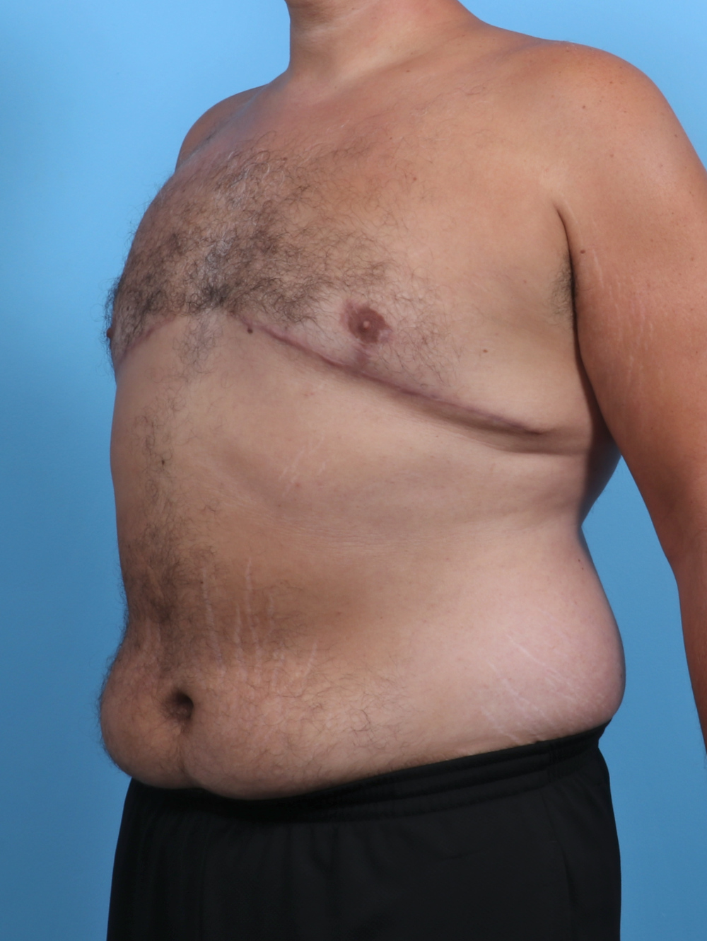 Male Breast Reduction Patient Photo - Case 3795 - after view-1