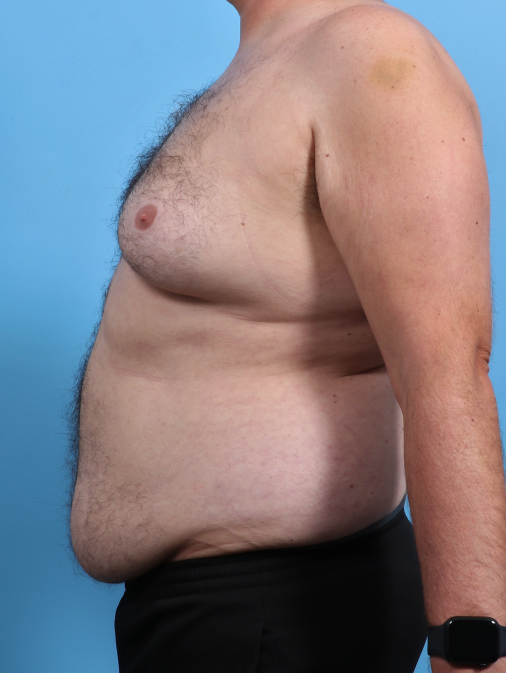 Male Breast Reduction Patient Photo - Case 3795 - before view-2