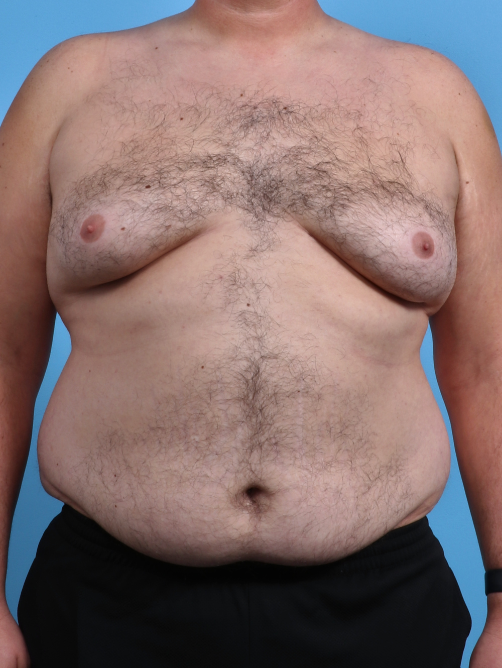 Male Breast Reduction Patient Photo - Case 3795 - before view-0