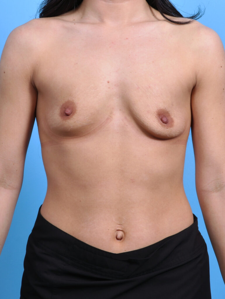 Breast Augmentation - Case 3811 - Before