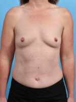 Breast Augmentation - Case 3819 - Before