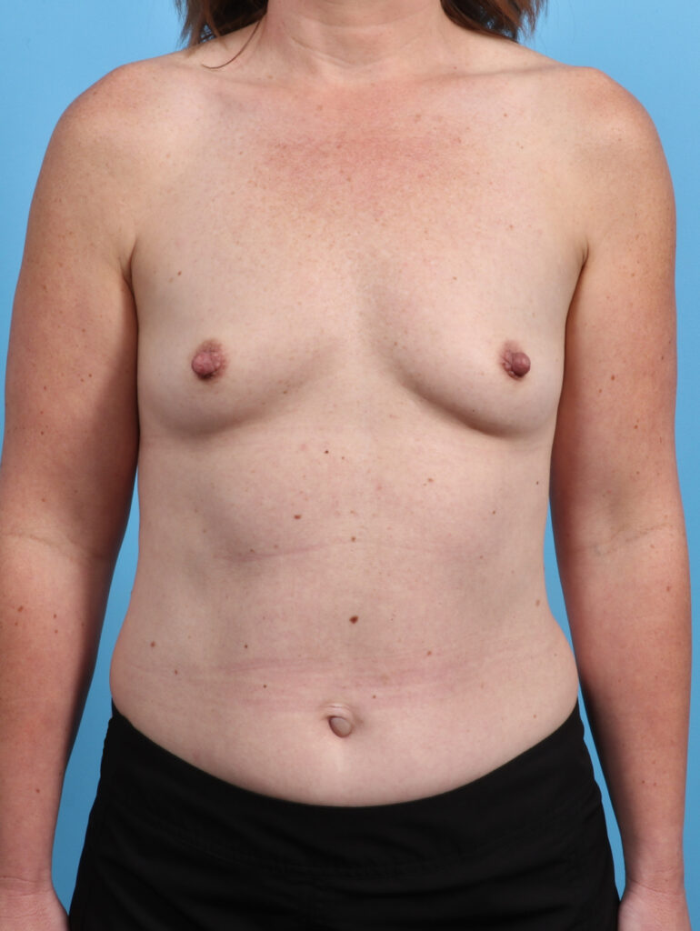 Breast Augmentation - Case 3819 - Before