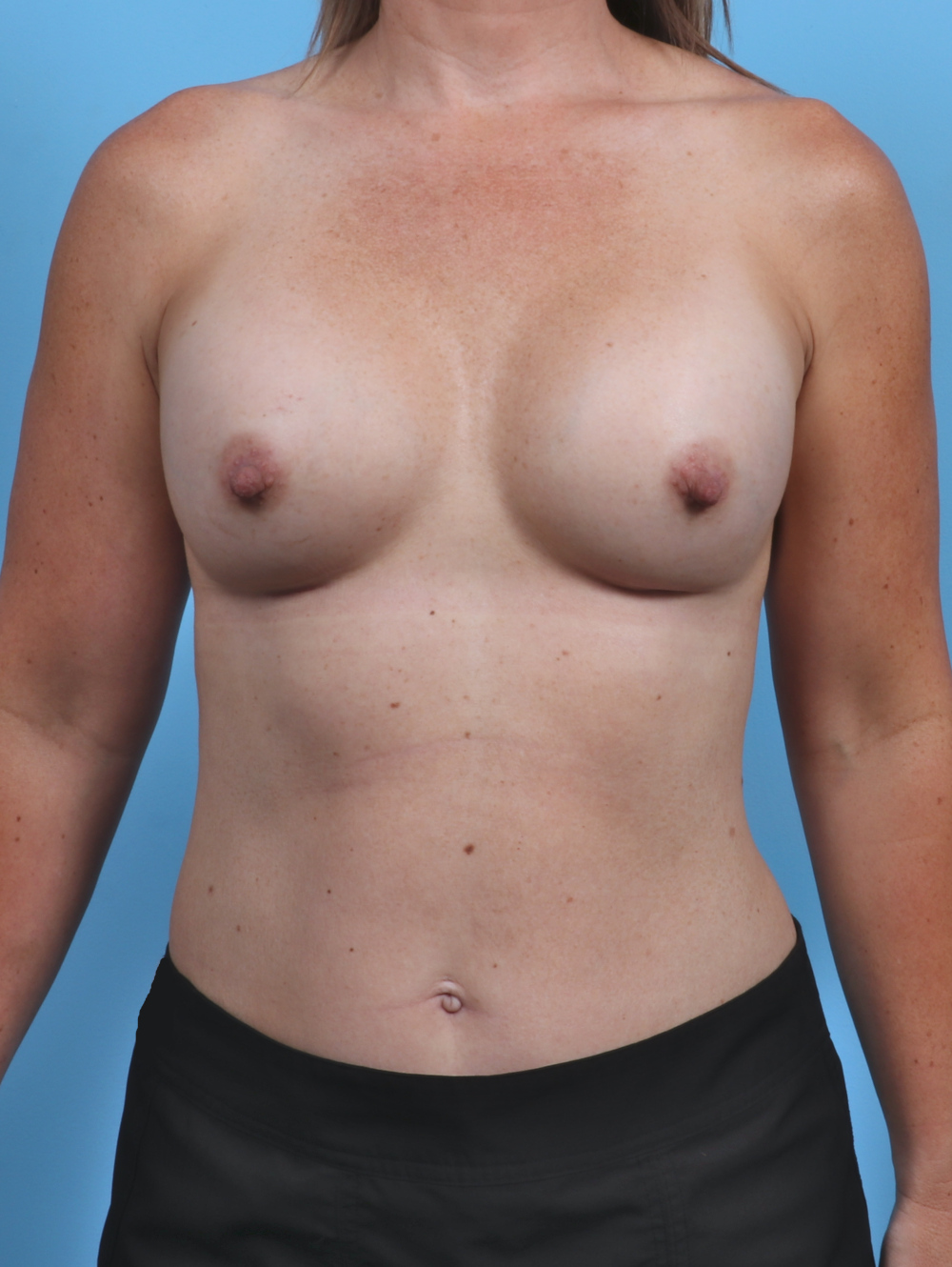 Breast Augmentation Patient Photo - Case 3819 - after view