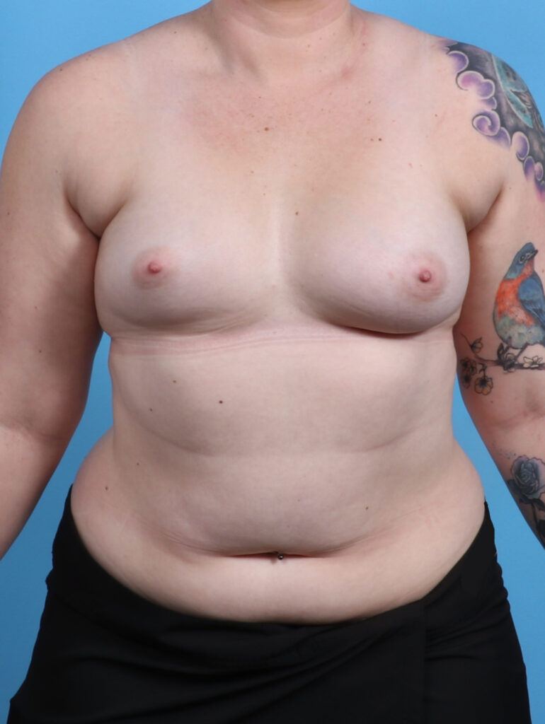 Breast Lift with Implants - Case 3864 - Before