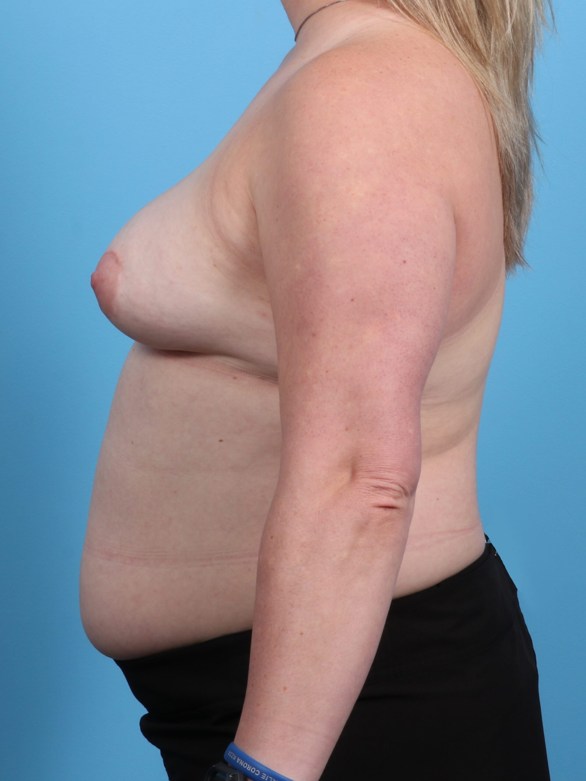 Breast Implant Revision Patient Photo - Case 3890 - before view-2