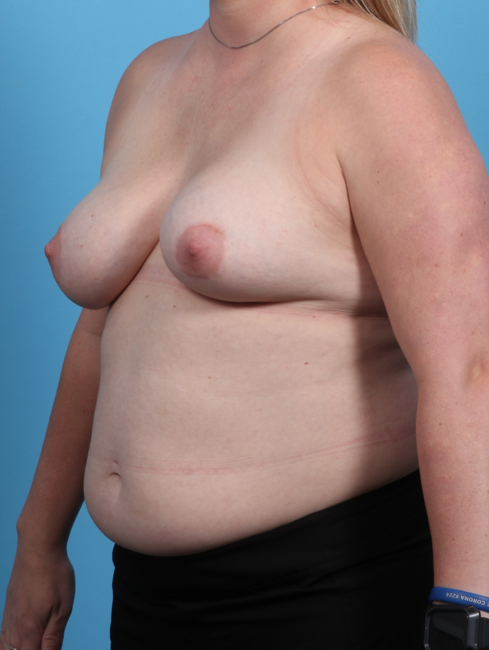 Breast Implant Revision Patient Photo - Case 3890 - before view-1