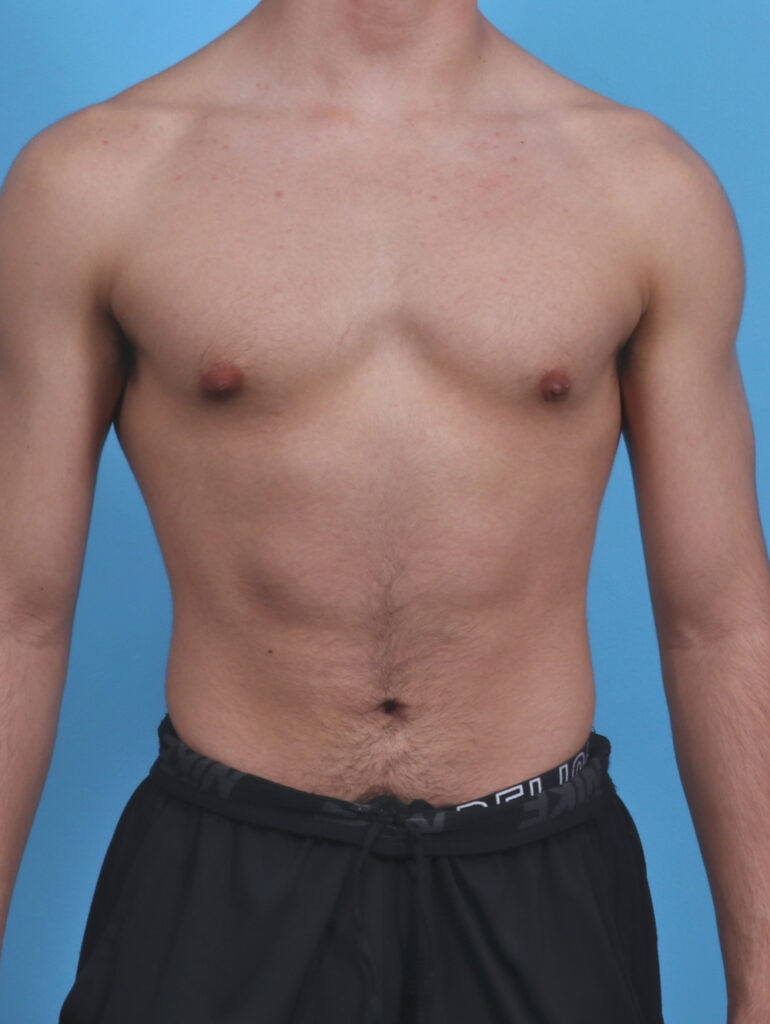 Male Breast Reduction - Case 3906 - After