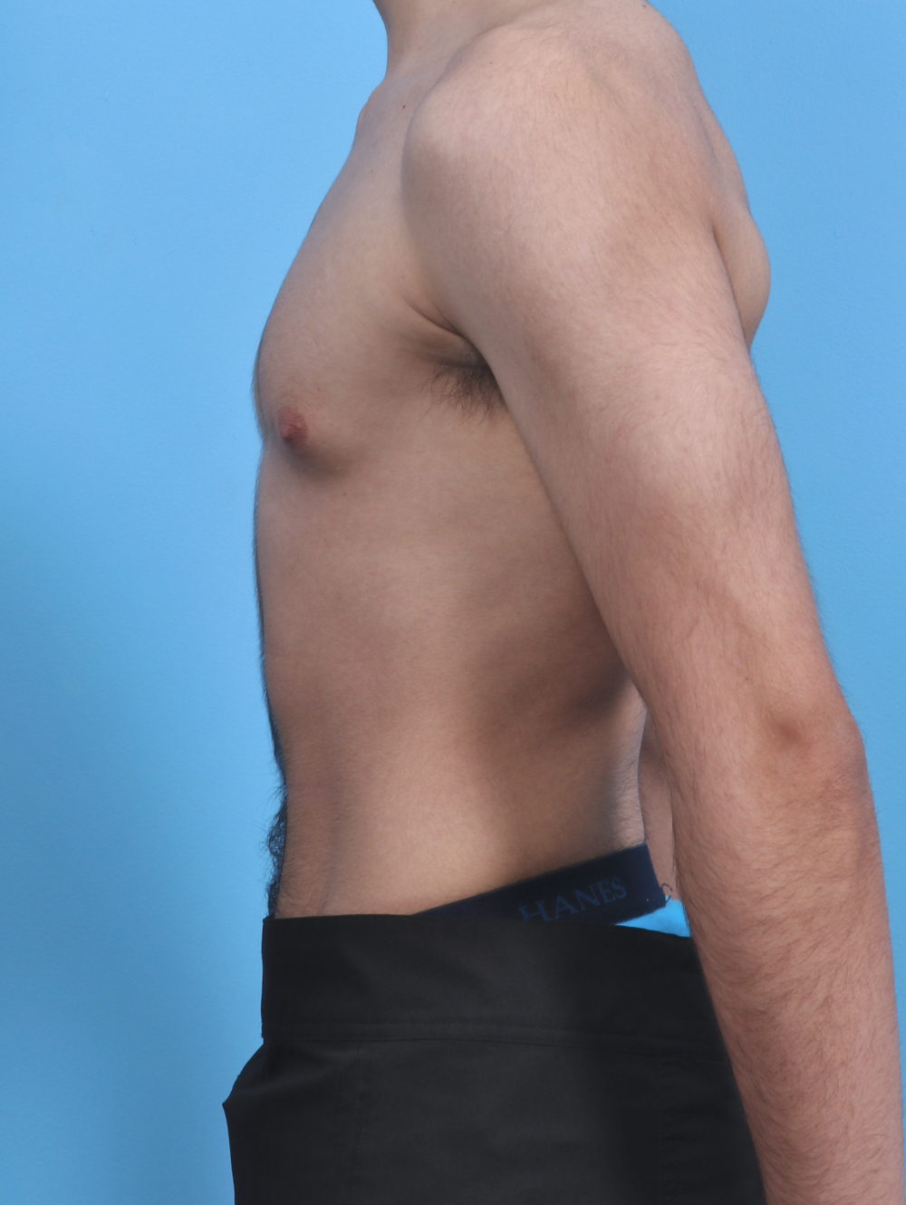 Male Breast Reduction Patient Photo - Case 3906 - before view-2