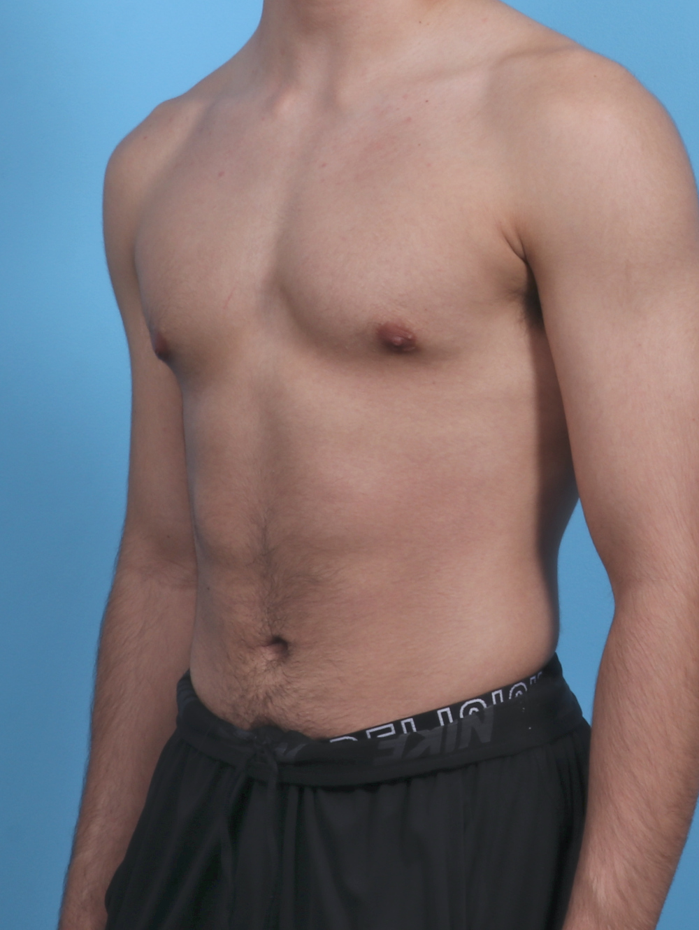 Male Breast Reduction Patient Photo - Case 3906 - after view-1