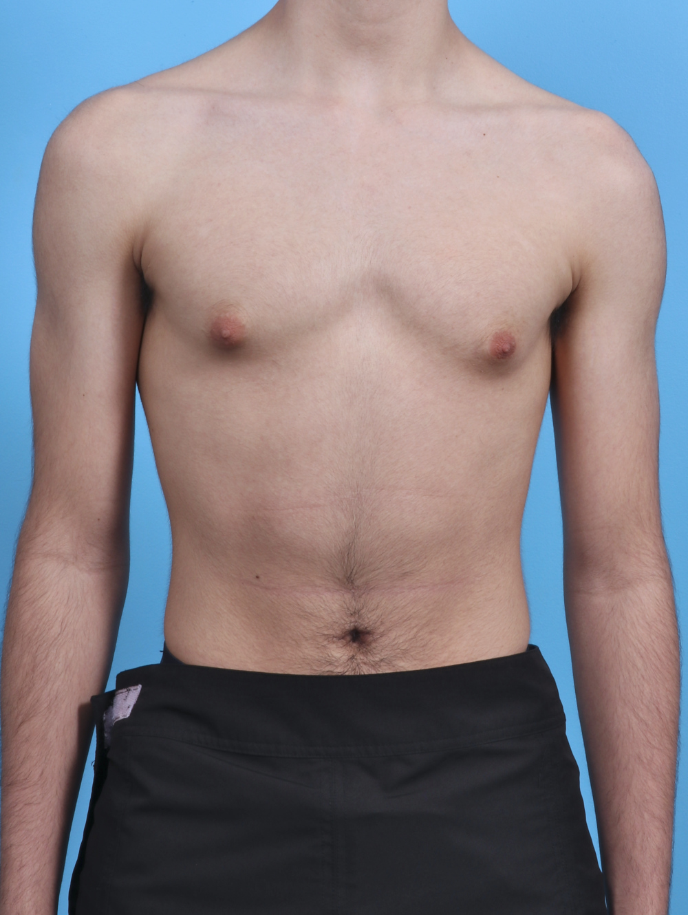 Male Breast Reduction Patient Photo - Case 3906 - before view-
