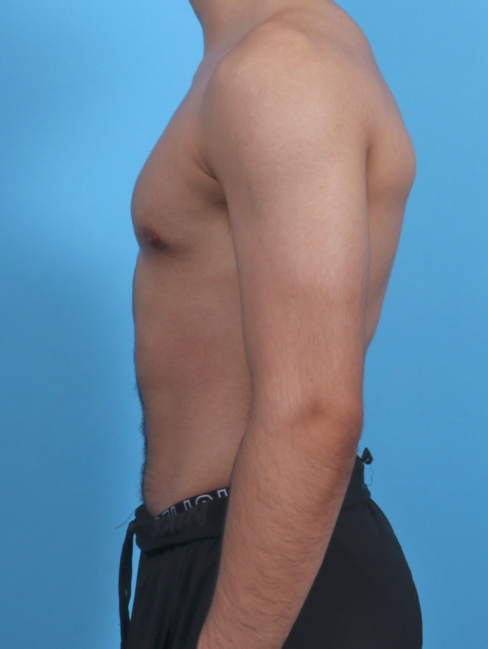 Male Breast Reduction Patient Photo - Case 3906 - after view-2