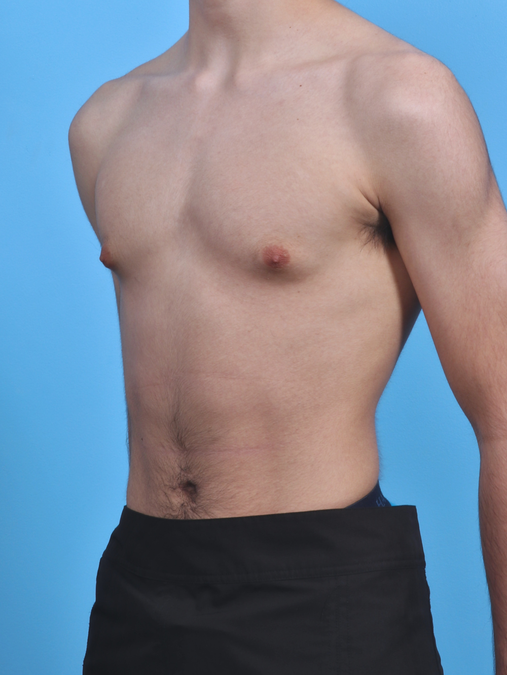 Male Breast Reduction Patient Photo - Case 3906 - before view-1