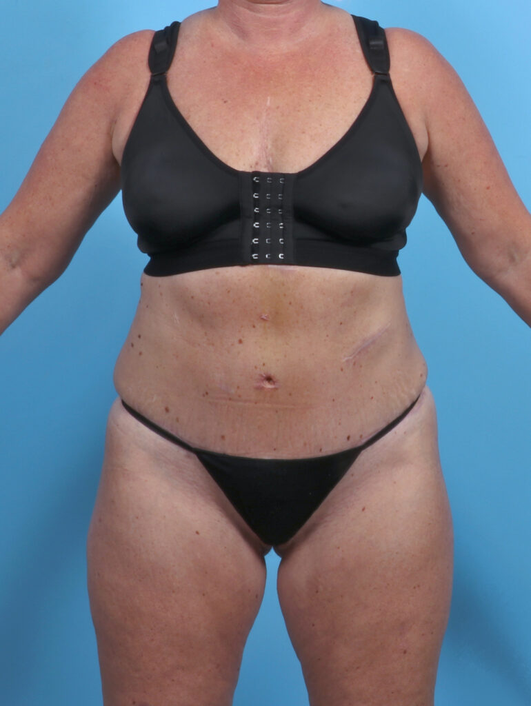 Liposuction - Case 3914 - After