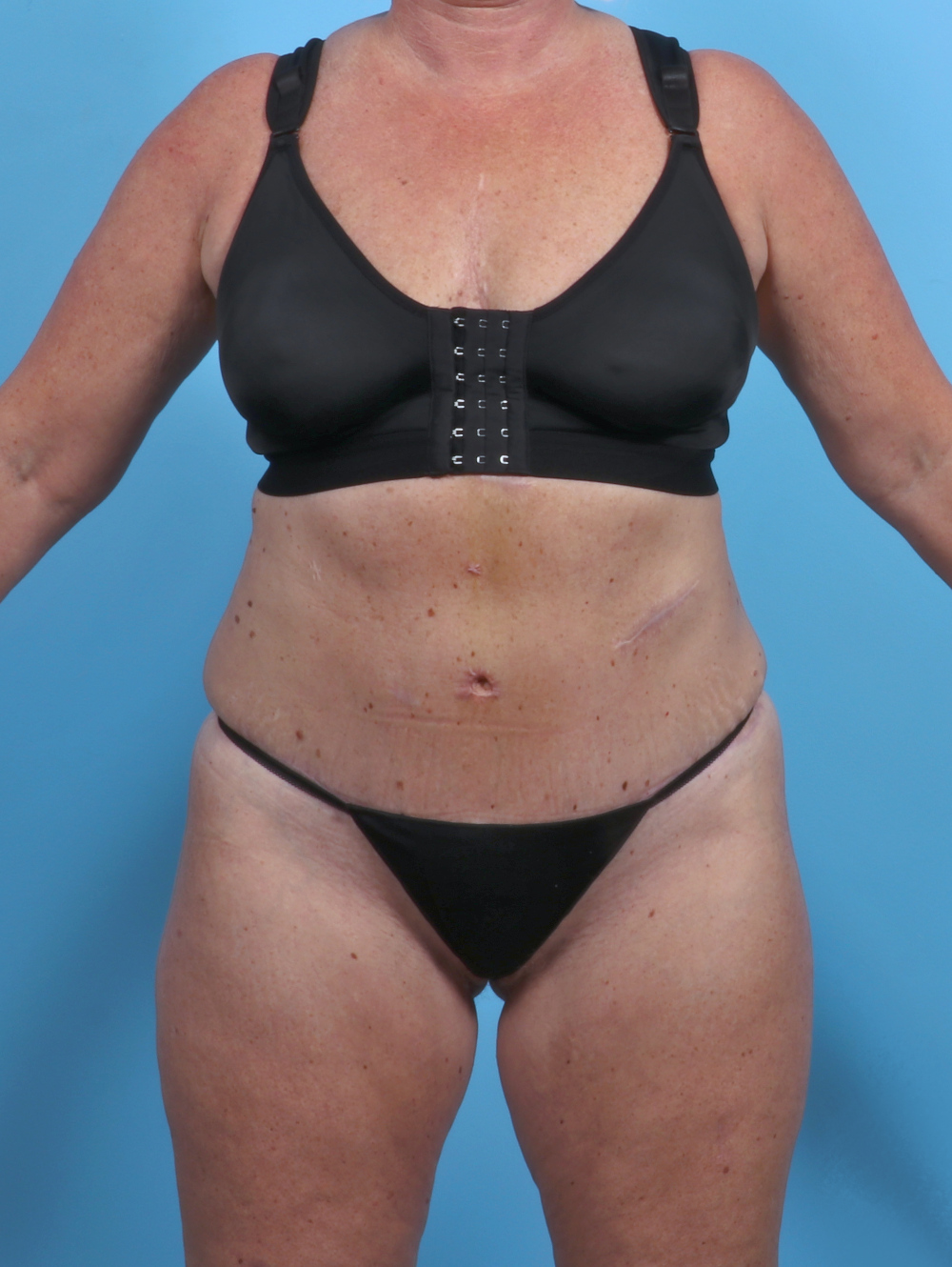 Liposuction Patient Photo - Case 3914 - after view-0
