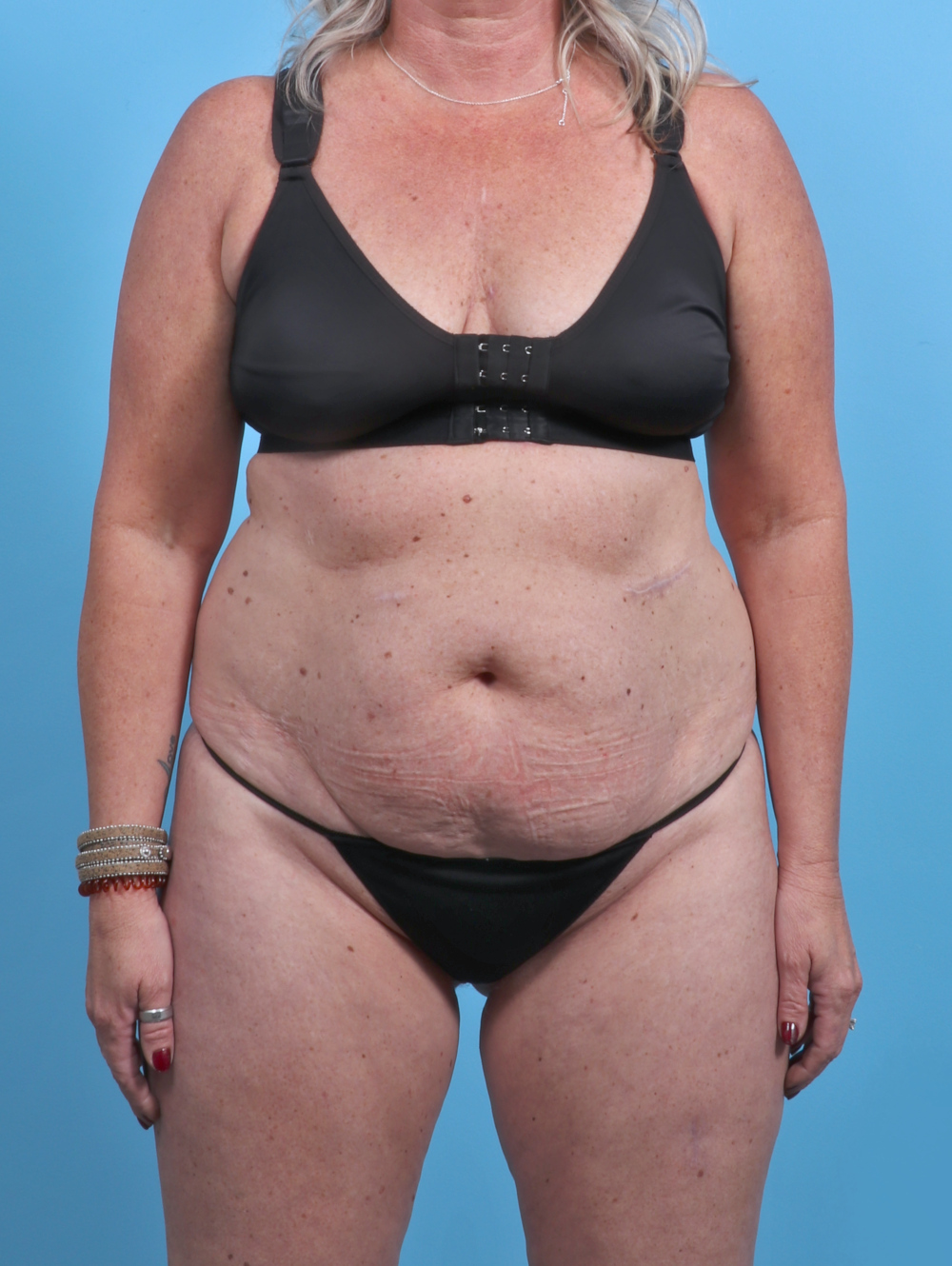 Liposuction Patient Photo - Case 3914 - before view-