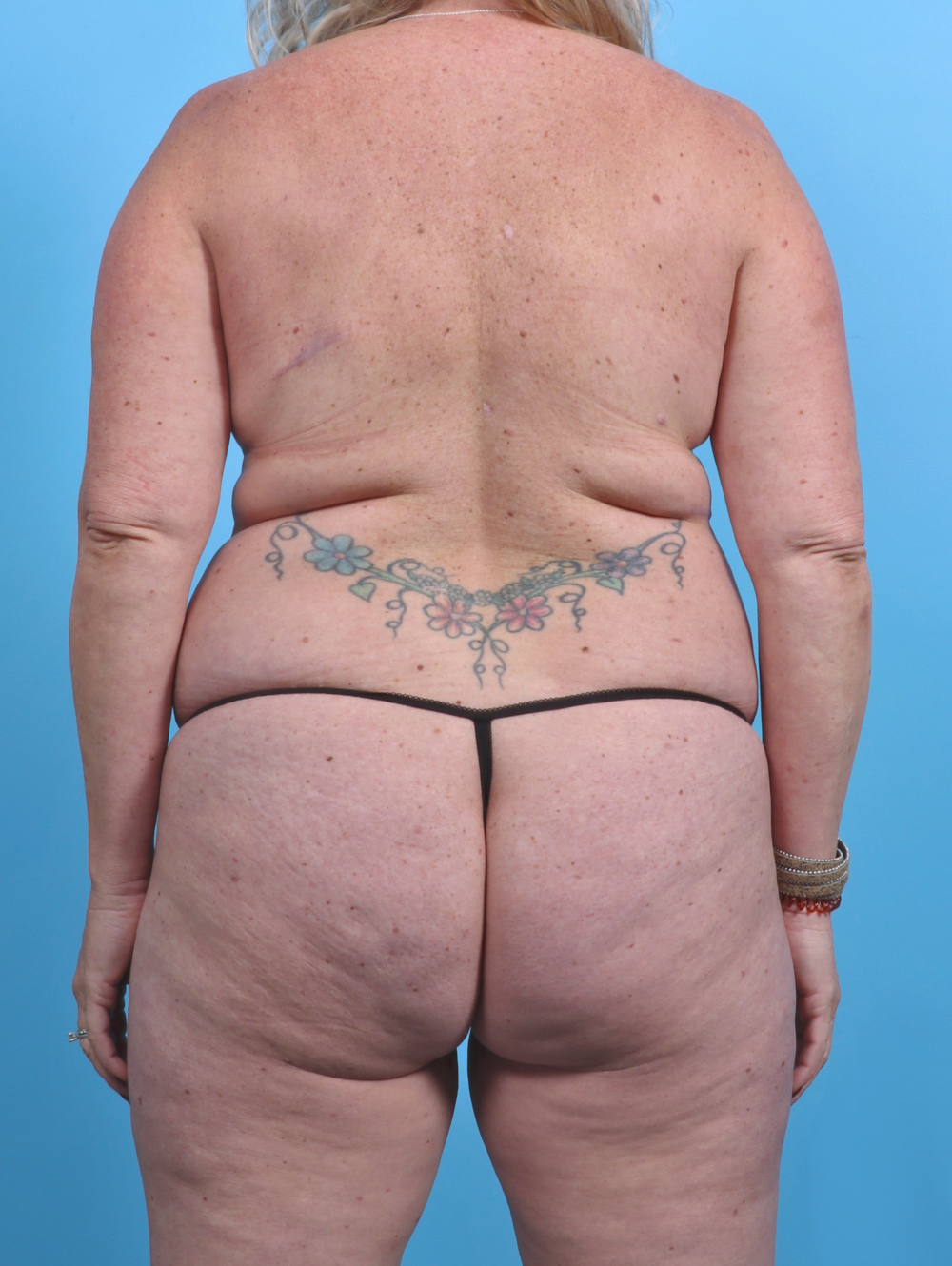 Liposuction Patient Photo - Case 3914 - before view-1