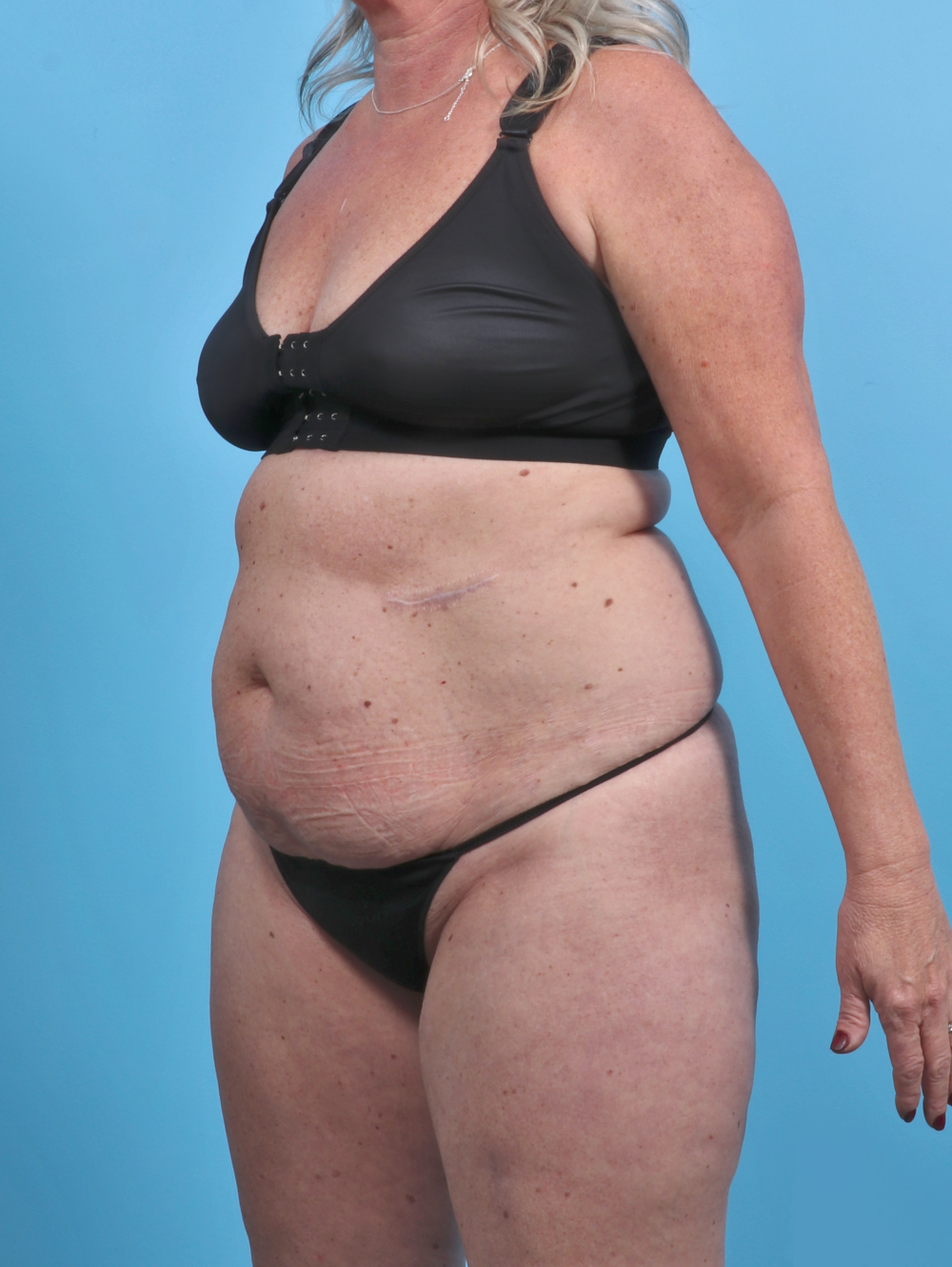 Liposuction Patient Photo - Case 3914 - before view-2