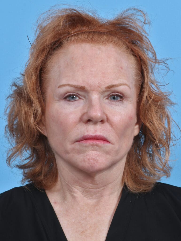 Brow Lift - Case 3925 - Before