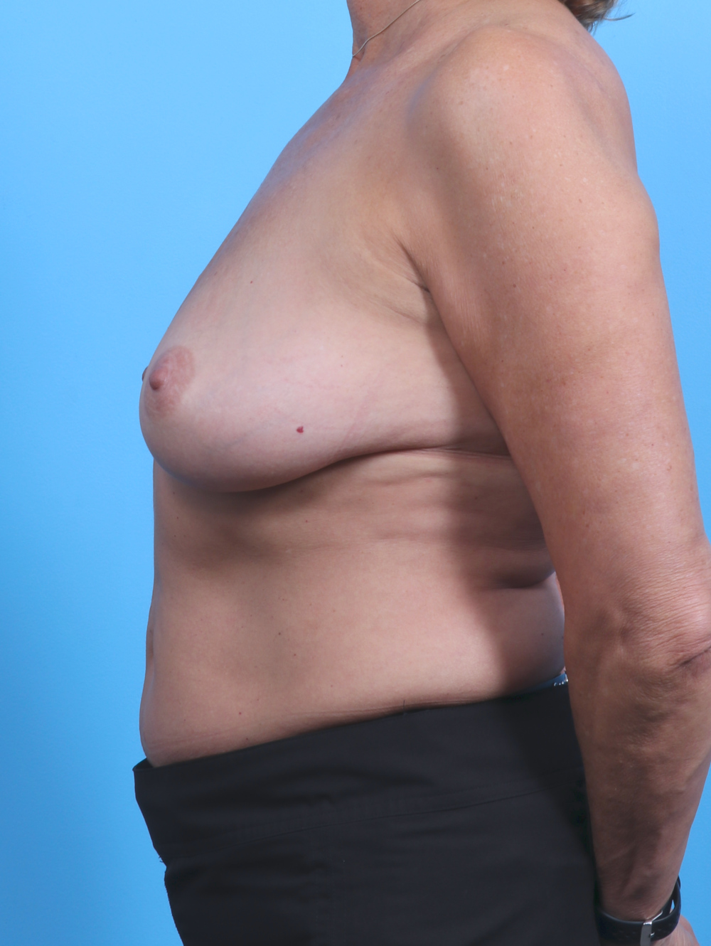 Breast Lift with Implants Patient Photo - Case 3951 - before view-2
