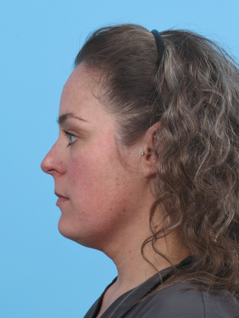 Facial Liposuction Patient Photo - Case 3975 - before view-2