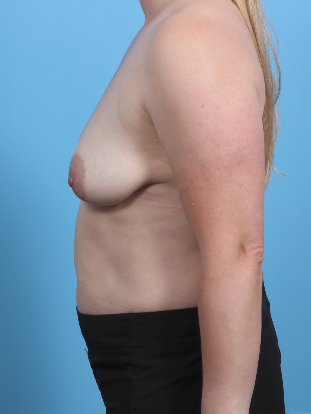 Breast Lift with Implants Patient Photo - Case 3983 - before view-2