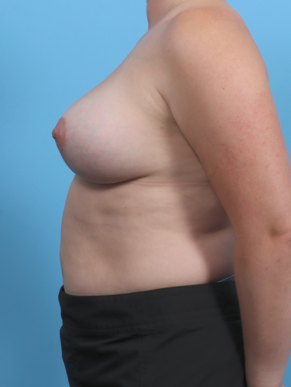 Breast Lift with Implants Patient Photo - Case 3983 - after view-2