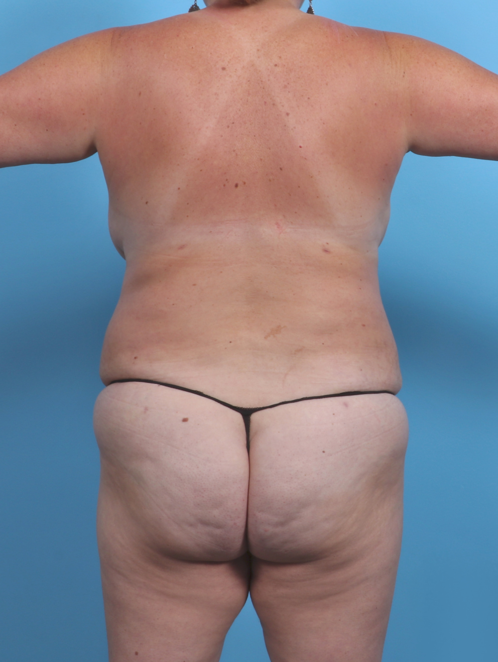 Liposuction Patient Photo - Case 3991 - after view-1